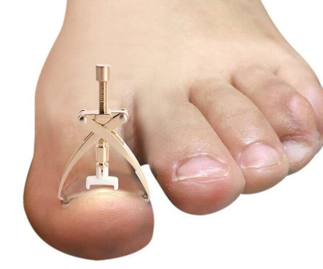 Ingrown Toe Nail Correction Tool - coolthings.us